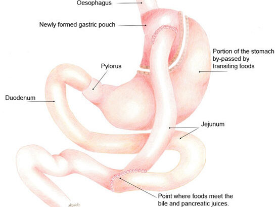 3 bypass