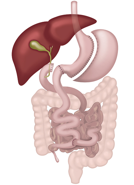 Biliopancreatic Diversion with Duodenal Switch