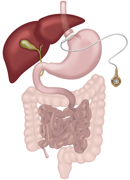 Adjustable Gastric Banding - Picture