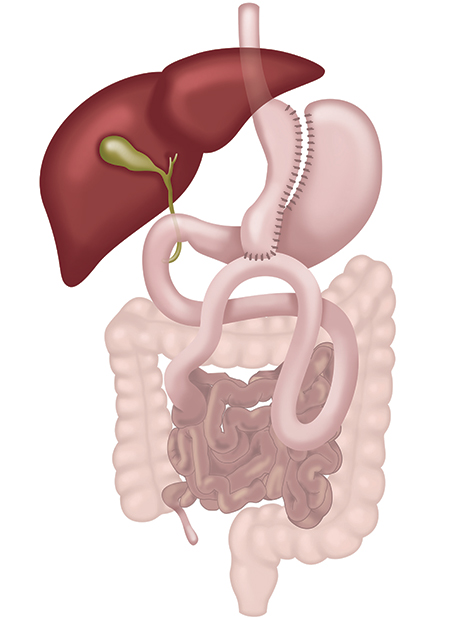 One Anastomosis Gastric Bypass