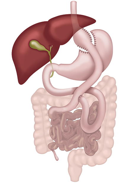 Roux-en-Y Gastric Bypass