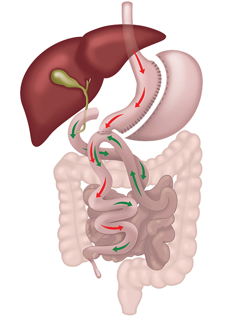 Single Anastomosis Duodeno-ileal with Sleeve Gastrectomy - Picture