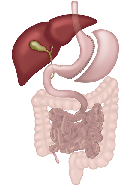 Sleeve Gastrectomy - picture