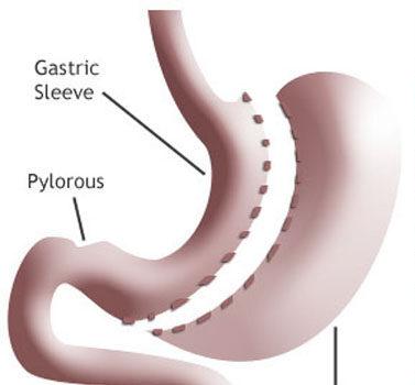Single-anastomosis bypass - an attractive alternative?