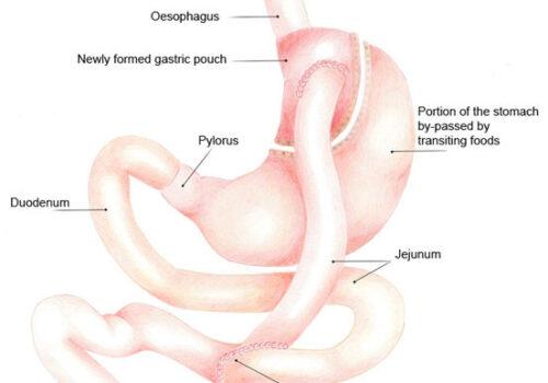 Surgery can benefit some obese pediatric patients
